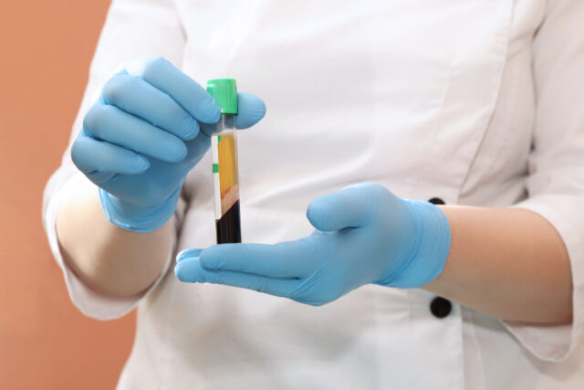 Platelet rich plasma in hands for PRP therapy