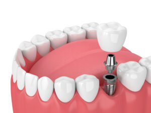 3d render of jaw with teeth and dental molar implant over white background