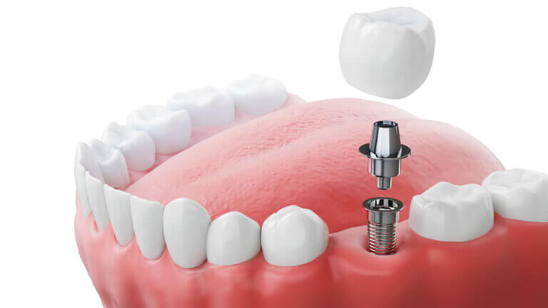 Dental Implant